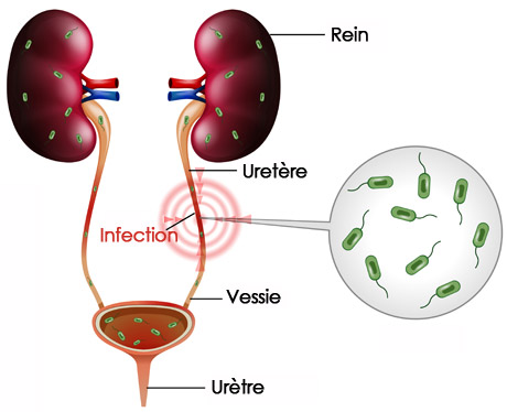 Infections Urinaires et Spina Bifida - Spina Bifida