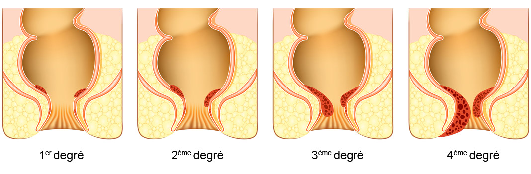 Degrés hémorroïdes