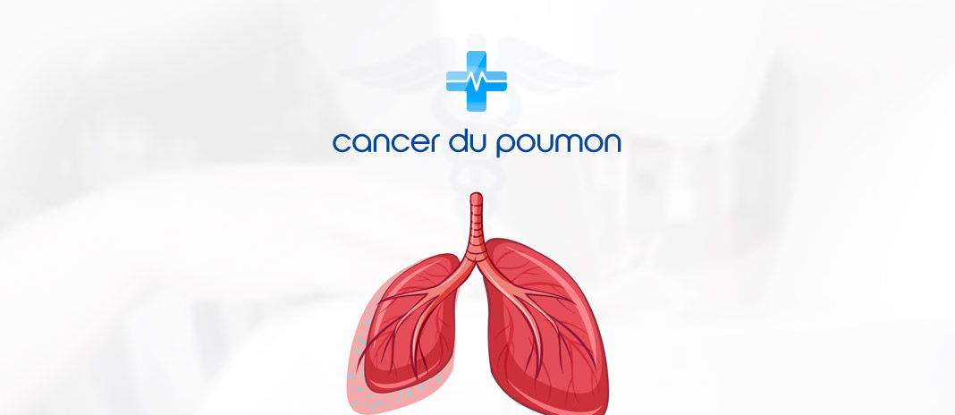 ≡ Cancer du Poumon : Symptômes, Diagnostic, Traitements et Guérison