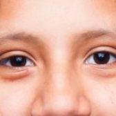 Poches sous les yeux : causes et remèdes