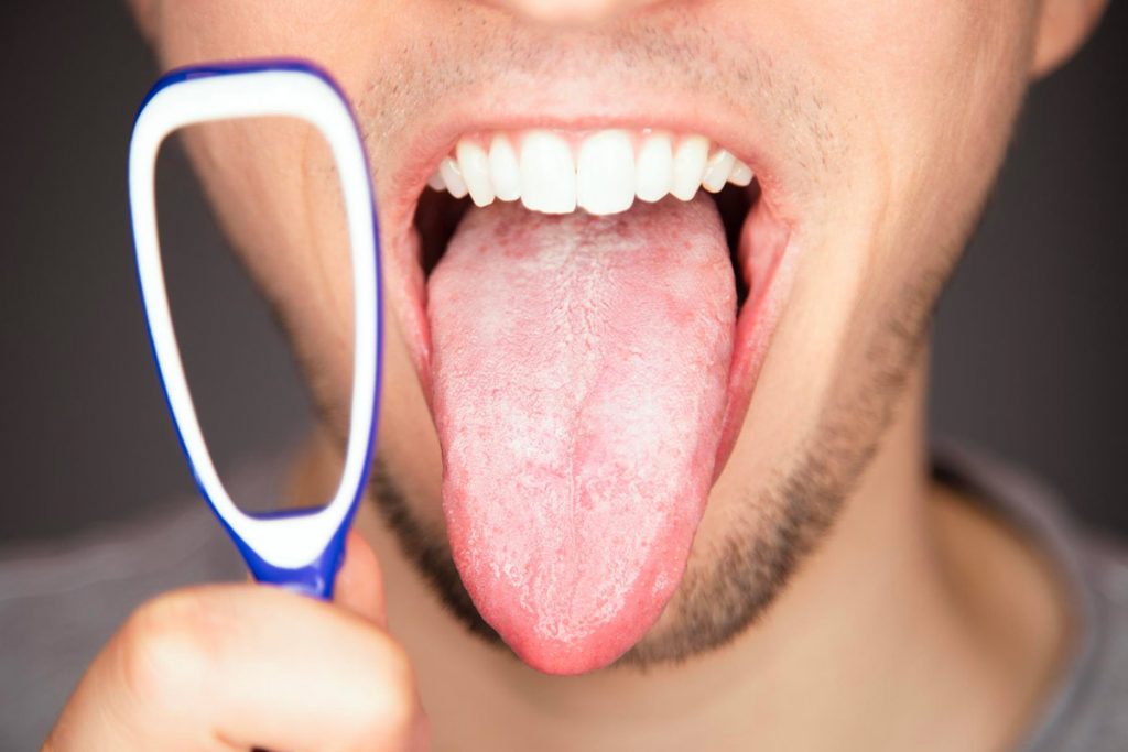 ≡ Langue Blanche : Faut-il s'inquiéter ? Quelles Solutions