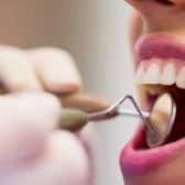 Comment prendre soin de ses implants dentaires ?