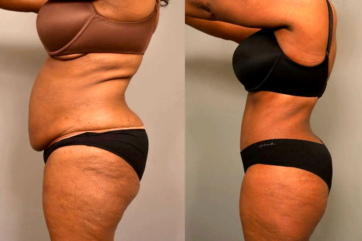 Avant-après une liposuccion du ventre
